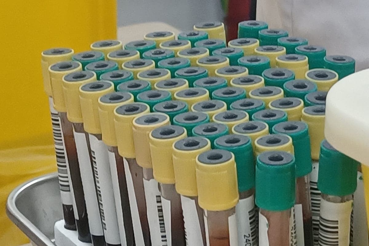 Lipoproteína(a) Alta: O Exame de Colesterol Que Quase Ninguém Pede