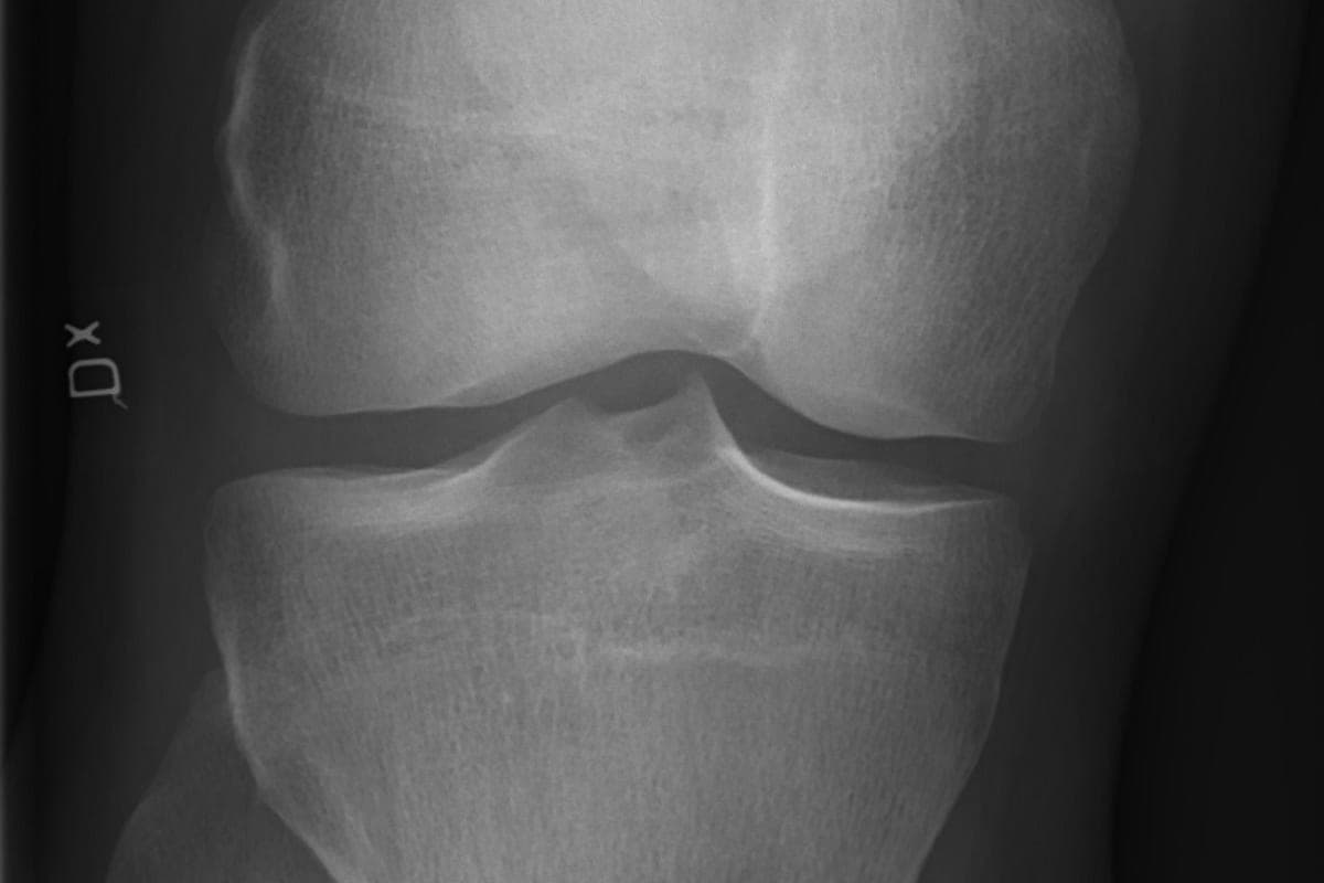 Artrose no Joelho: Dá Para Tratar (e Prevenir) Sem Cirurgia?